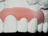 A gingival prosthetic is sculpted from acrlyic